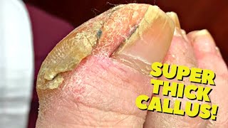 THICK Cracked Callus Trimming Satisfying [upl. by Aleron]