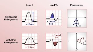 Intro to EKG Interpretation  Chamber Enlargement [upl. by Yrellih]