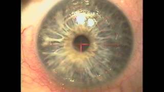 Corneal scar to 2020 Advanced Laser technique for HERPES Corneal scar to Gulani Vision [upl. by Santana]