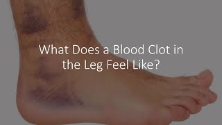 What Does a Blood Clot in the Leg Feel Like [upl. by Assirram]