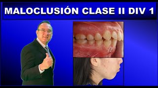 MALOCLUSION CLASE 2 DIVISION 1 DE ANGLE  ORTODONCIA [upl. by Ahsenik]