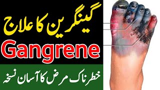 Gangrene ka Ilaj  گینگرین کا علاج  Hakeem Zia Shahid [upl. by Lav]