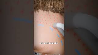 How a hair transplant is done [upl. by Flosser63]