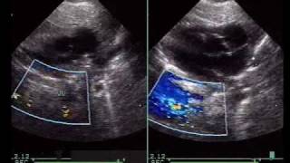 Total Anomalous Pulmonary Venous ConnectionTAPVC [upl. by Sapphera]