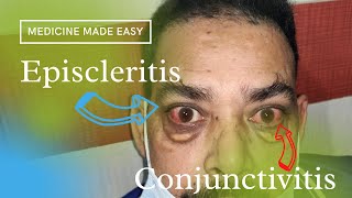 Clinical Finding Episcleritis and Conjunctivitis in a patient of Potts Disease [upl. by Thomson]