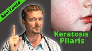 KERATOSIS PILARIS Fix Sign of Serious Condition Chicken Skin Cure [upl. by Nabala]