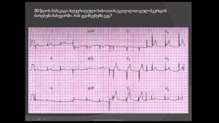 ეკგ ნაადრევი რეპოლარიზაციის სინდრომი ST სეგმენტის მაღალი გამოსვლის სინდრომი [upl. by Aimar]