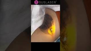 SUSLASER Underarm Carbon Peeling For Underarm Pigment removal amp Whitening [upl. by Aihseym]