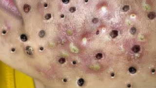 Skincare Pimples Popping Biggest Blackheads Removal 272 [upl. by Eille]