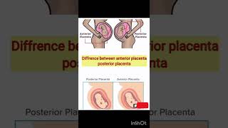 Difference between anterior placenta posterior placenta  anterior  posterior [upl. by Worthy]