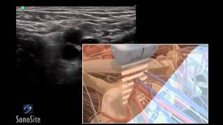 How To Ultrasound Guided Insertion of a Femoral Vein Catheter 3D Video [upl. by Eenert]