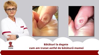 Bataturi la degete 👉 cum am tratat astfel de batatura mamei [upl. by Turmel]