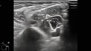 부리상완근 coracobrachialis musculocutaneous nerve [upl. by Yrennalf]