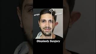 Otoplasty Surgery earsurgery [upl. by Naujet755]