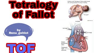 Tetralogy of Fallot TOF  component of TOF pathophysiology symptoms investigation and treatment [upl. by Allsopp844]