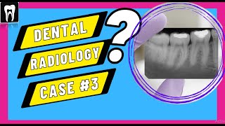 Dental Radiology Case3 Radiographic Interpretation DENTAL CASE DISCUSSION Facial space infection [upl. by Maryanne580]