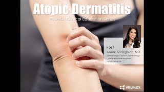 Atopic Dermatitis VisualDx Clinical Education Series [upl. by Anamuj110]