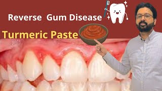 How to use TURMERIC Paste to Reverse Gingivitis Bleeding Gums and Receding Gums [upl. by Ancel]