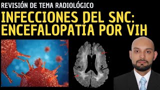 Radiología en 5 minutos Infecciones del sistema nervioso central Encefalopatía por VIH [upl. by Aokek]