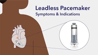 Transformative world of leadless pacemakers [upl. by Baler]