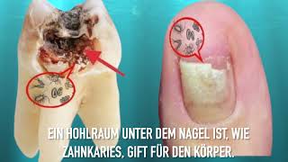 Hohlraum unterm Nagel [upl. by Caresa]