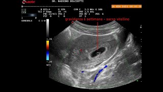 gravidanza alla 6° settimana di gestazione [upl. by Greenwood]