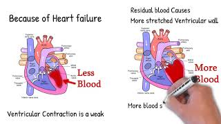 Pulsus alternans  alternation of one strong and one weak beat [upl. by Oyam]