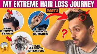 My Hair Loss Treatment Journey ft Man Matters Part 2  How to Control Hair Fall for Men ANKIT TV [upl. by Corinna]