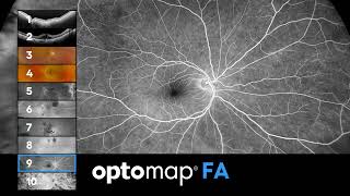 optomap  10 imaging modalities [upl. by Brnaba]