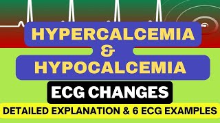 Hypercalcemia and Hypocalcemia ECG changes with 6 Examples Mechanism and Detailed Explanation [upl. by Odrarebe]