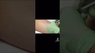 Removing birth control implant [upl. by Nwahsal131]