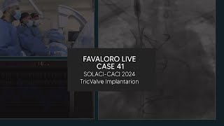 Favaloro Live Case N° 41  SOLACICACI 2024  TricValve Implantarion [upl. by Laufer423]