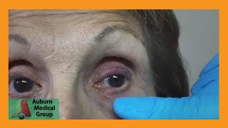 A Stye and a Chalazion  Auburn Medical Group [upl. by Atiseret]