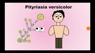 2 Pityriasis versicolor السعفة المبرقشة Malassezia furfur [upl. by Areivax566]