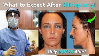 What Can I Expect During Rhinoplasty Recovery One Day to Three Weeks PostOp [upl. by Maiocco102]