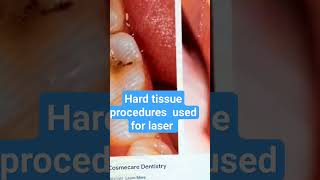 What are the hard tissue procedures used for laser dentistryshortshard tissue lasercavities [upl. by Portugal]