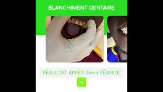 Clinique Dentaire Dabia « Blanchiment Dentaire » [upl. by Nnylrac]