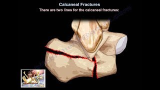 Calcaneal Fractures  Everything You Need To Know  Dr Nabil Ebraheim [upl. by Siol120]