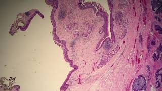 Adenoid Cystic Carcinoma Predominantly Solid Variant [upl. by Nilahs151]