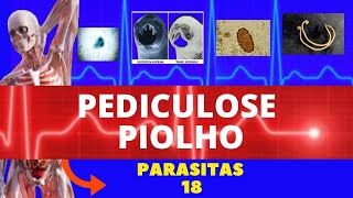 PEDICULOSE PIOLHO  PEDICULUS HUMANUS E PTHIRUS PUBIS  PARASITOLOGIA INFECTOLOGIA [upl. by Yrrem]