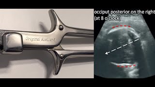 Seeing is believing Kiellands Forceps Rotation under Ultrasound [upl. by Witt756]