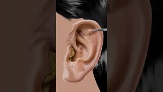 ASMR Itchy amp Smelly Ear Stone Removal ASMR Clinic [upl. by Carpet]