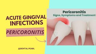 ACUTE GINGIVAL INFECTION PERICORONITIS [upl. by Eizle]