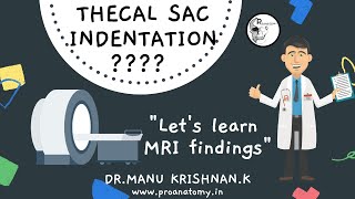 What is Thecal Sac indentation  Learn to read MRI [upl. by Naleag]