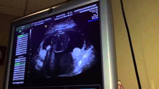 20 Week Ultrasound Gender amp Placenta Previa [upl. by Cavallaro]