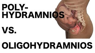 Polyhydramnios vs Oligohydramnios [upl. by Mahmoud980]