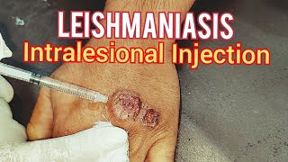 Leishmaniasis Treatment [upl. by Yraccaz]