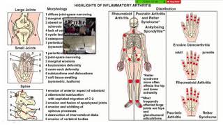 Approach to arthritis Dr Neeti Gupta [upl. by Leeda]