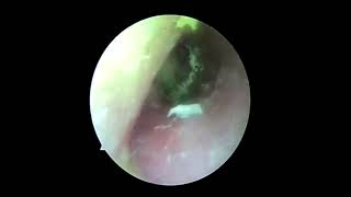 Ear wax removalsatisfying video for ear Fungus cleaning [upl. by Hnad]