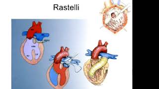 Le traitement percutané des cardiopathies congénitales en pédiatrie [upl. by Leelahk]